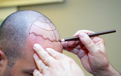 Who is a Candidate for a Hair Transplant?